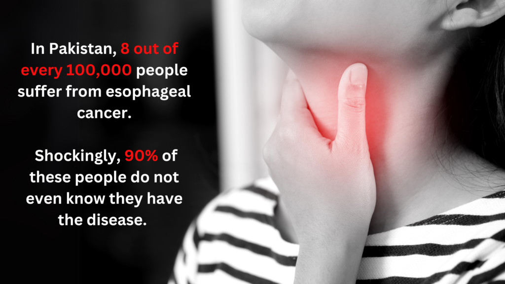 Esophageal cancer is a significant health concern in Pakistan, ranking 9th in Pakistani males and 5th in females.