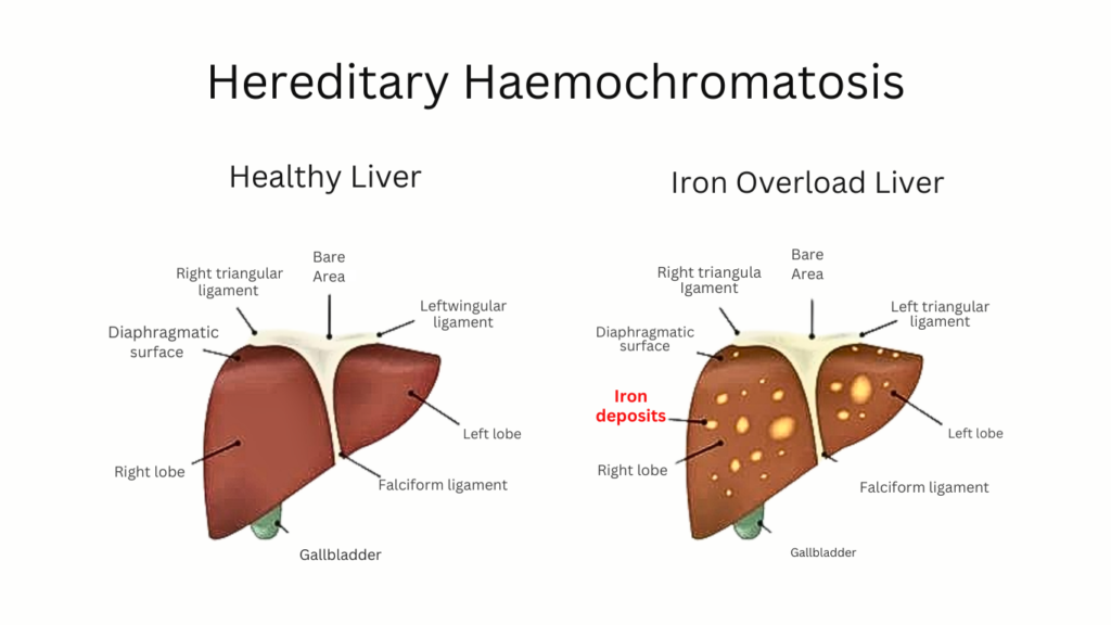 heathy liver vs iron overloaded haemochromatosis liver